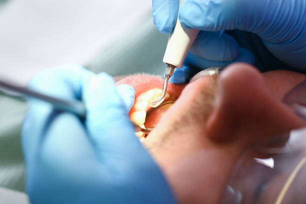 Best Emergency Wisdom Teeth Removal in Darien Downtown, CT